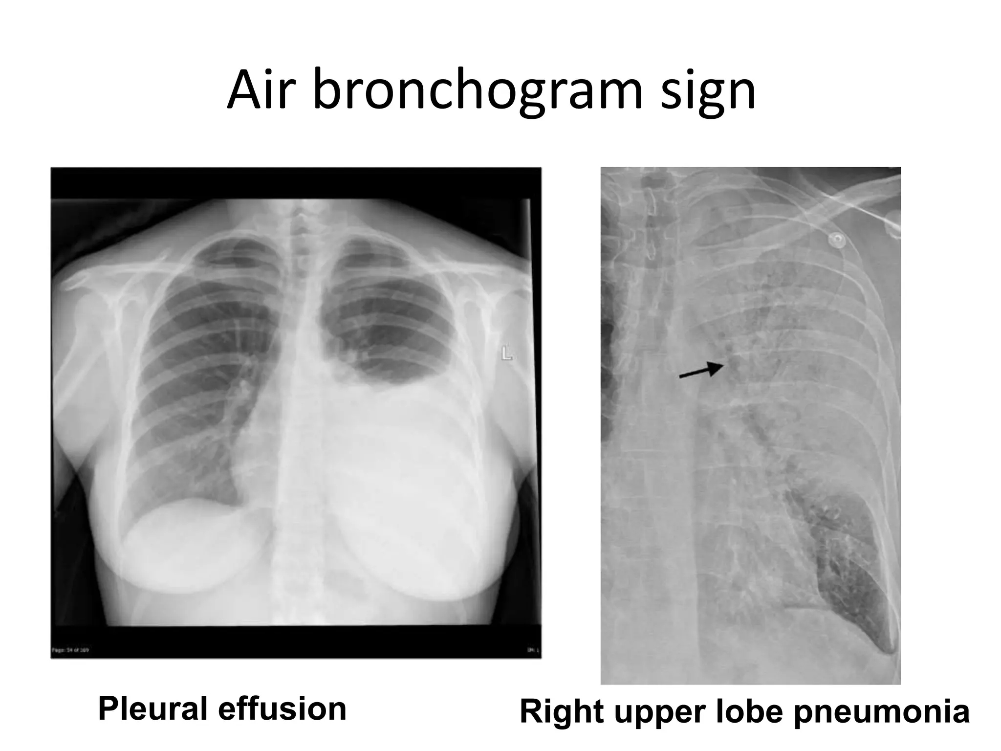 Air bronchogram sign
Pleural effusion Right upper lobe pneumonia
 