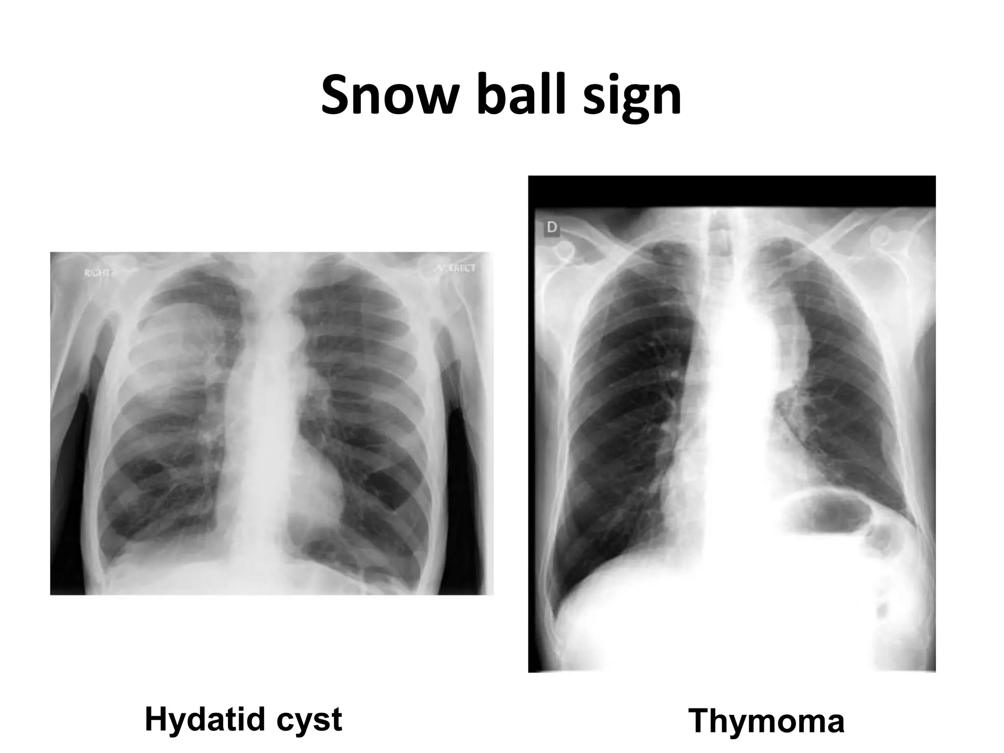 Snow ball sign
Thymoma
Hydatid cyst
 