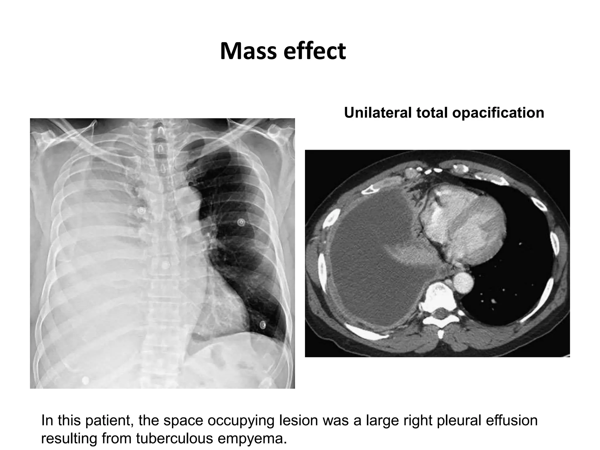 In this patient, the space occupying lesion was a large right pleural effusion
resulting from tuberculous empyema.
Unilateral total opacification
Mass effect
 