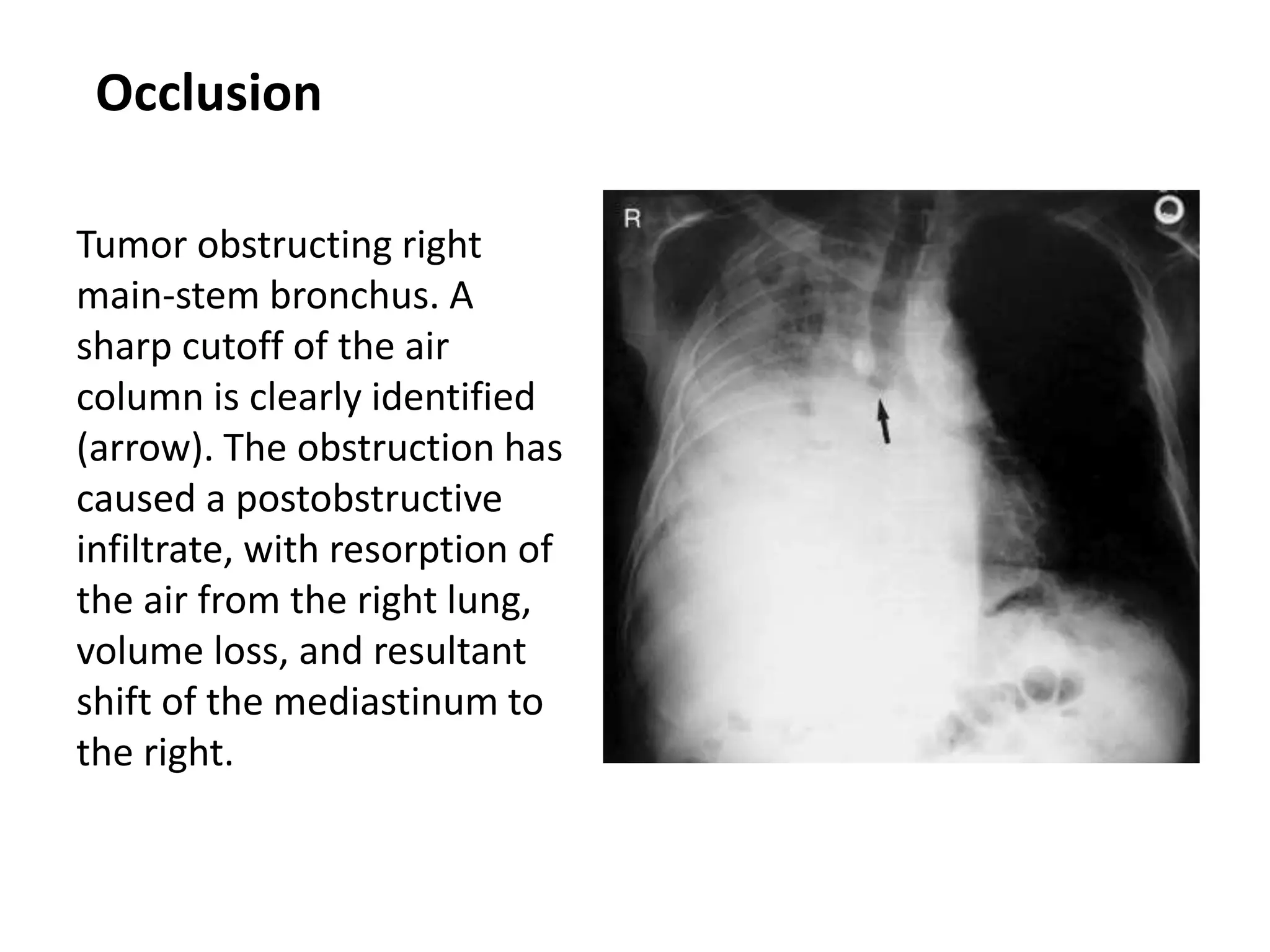 Occlusion
Tumor obstructing right
main-stem bronchus. A
sharp cutoff of the air
column is clearly identified
(arrow). The obstruction has
caused a postobstructive
infiltrate, with resorption of
the air from the right lung,
volume loss, and resultant
shift of the mediastinum to
the right.
 