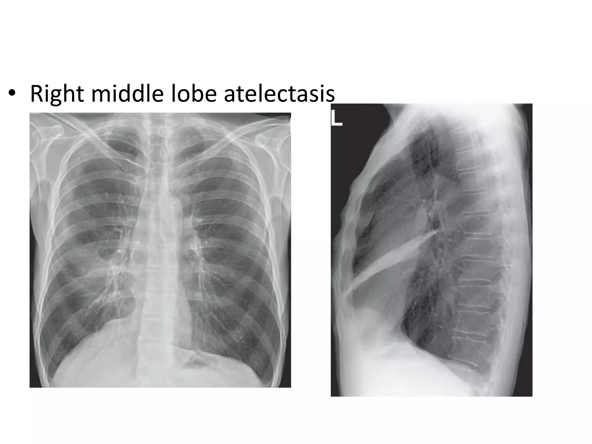 • Right middle lobe atelectasis
 