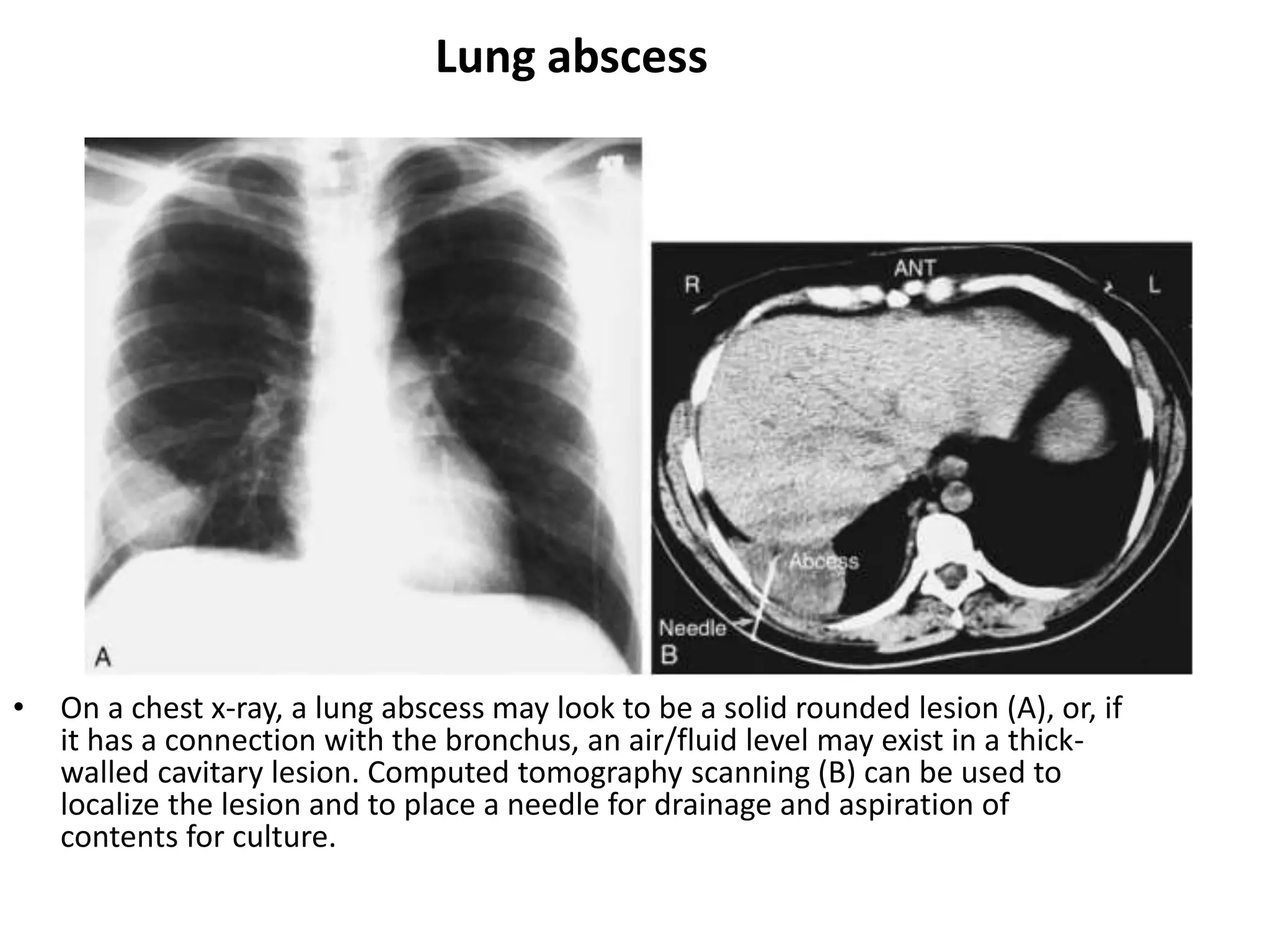 Lung abscess
• On a chest x-ray, a lung abscess may look to be a solid rounded lesion (A), or, if
it has a connection with the bronchus, an air/fluid level may exist in a thick-
walled cavitary lesion. Computed tomography scanning (B) can be used to
localize the lesion and to place a needle for drainage and aspiration of
contents for culture.
 
