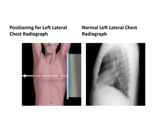Radiology respiratory new.ppt