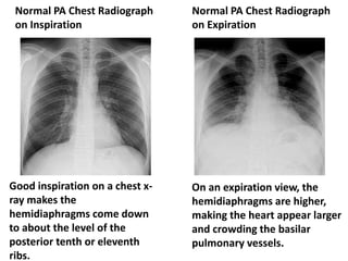 Pa Using Respiration Radiology respiratory new.ppt