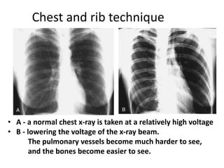 Radiology respiratory new.ppt