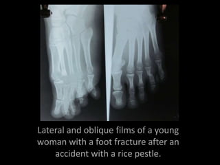 Lateral and oblique films of a young
woman with a foot fracture after an
    accident with a rice pestle.
 