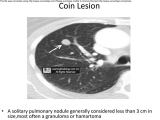 Coin Stack Sign Radiology Classical radiology signs by shah zeb.pdf