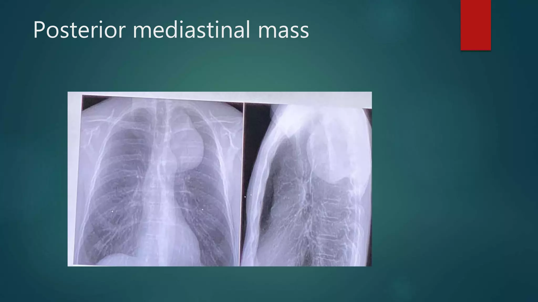 Posterior mediastinal mass
 