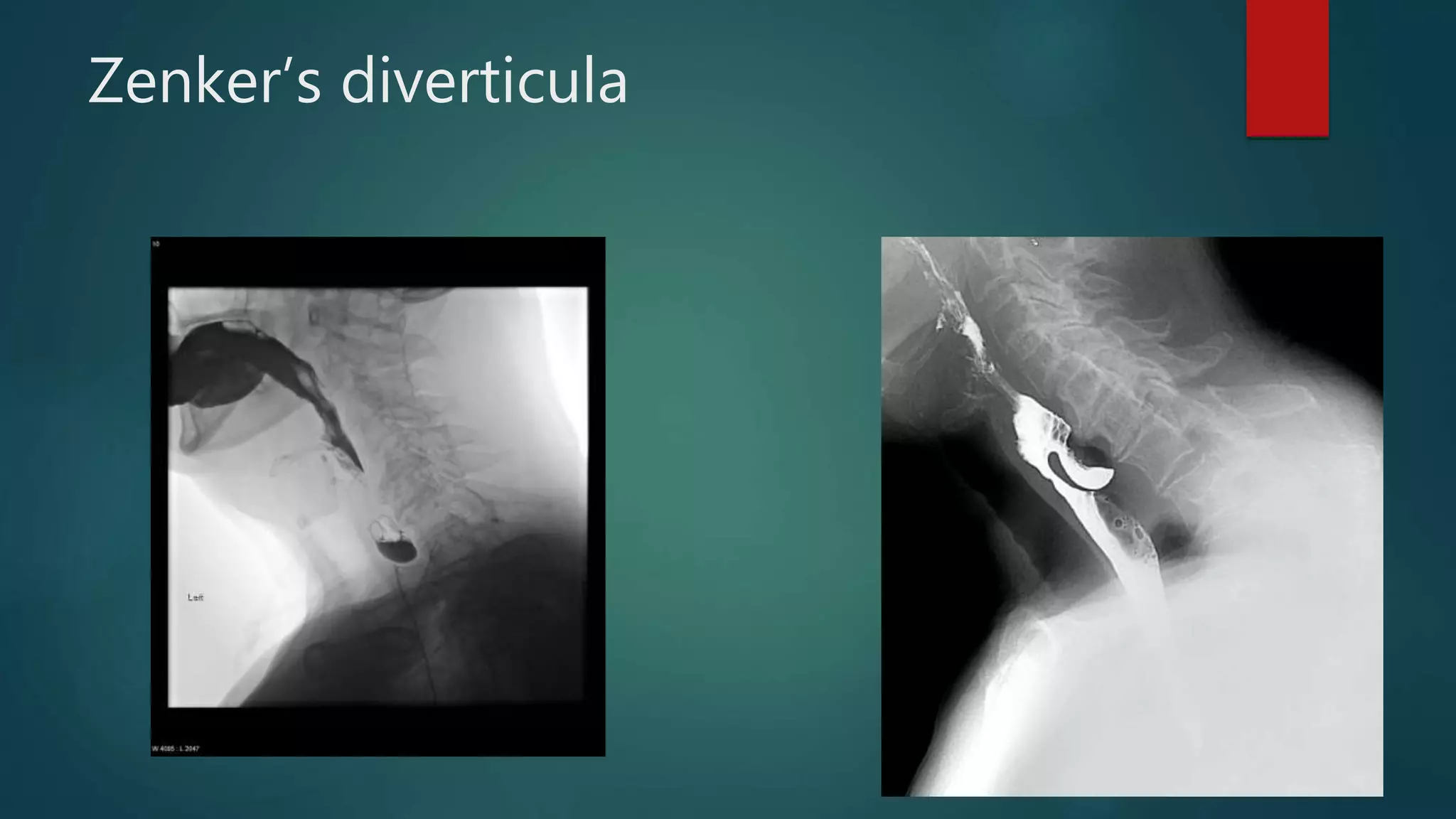 Zenker’s diverticula
 