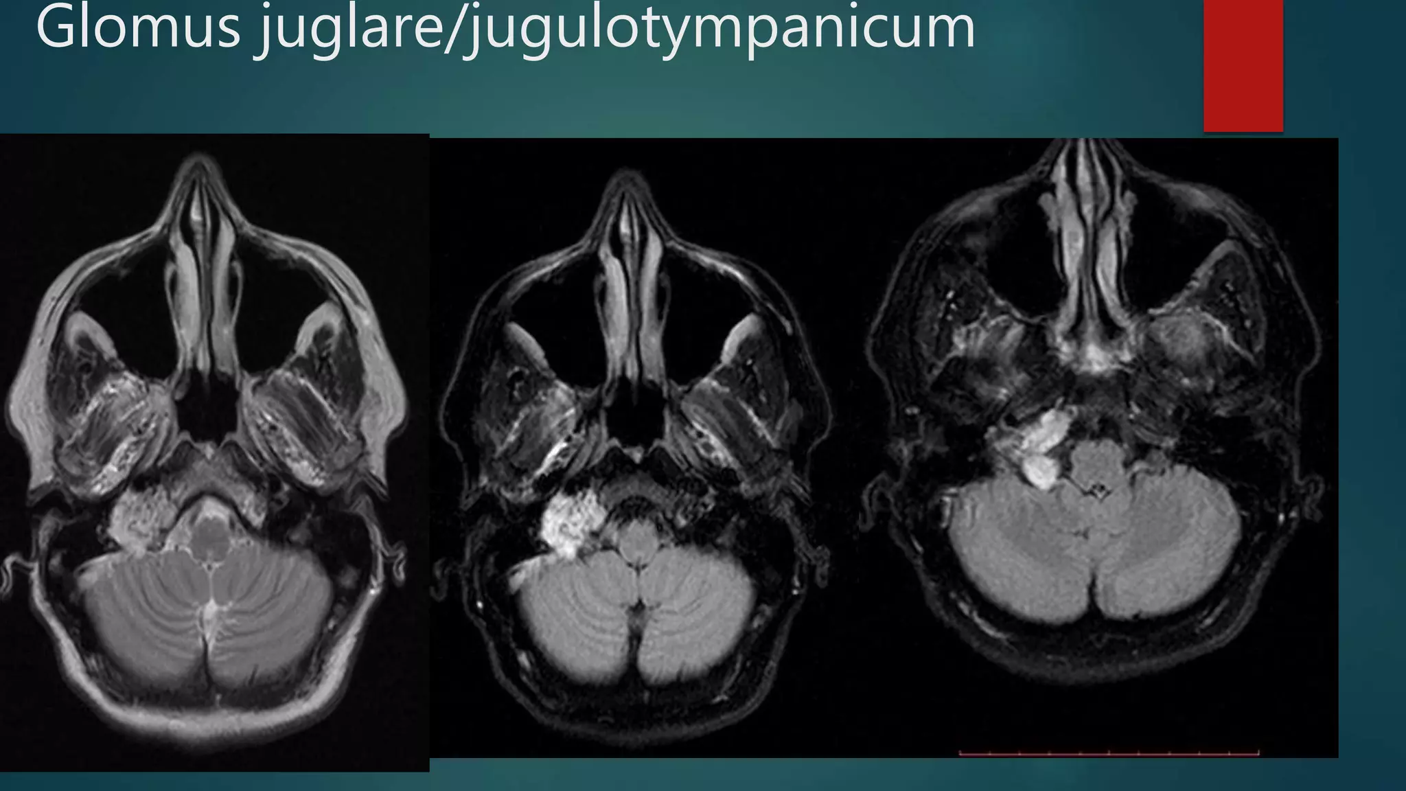 Glomus juglare/jugulotympanicum
 