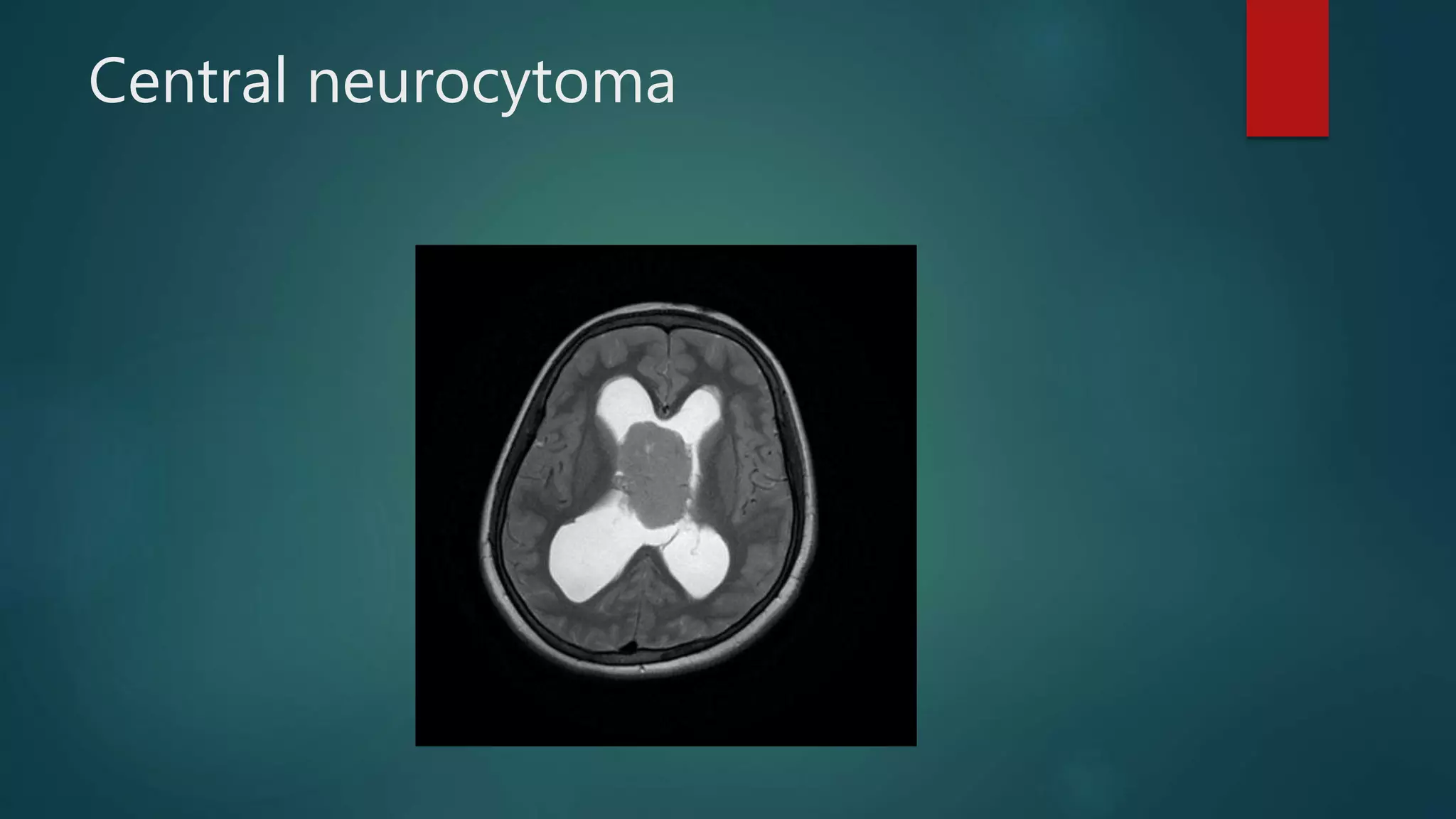 Central neurocytoma
 