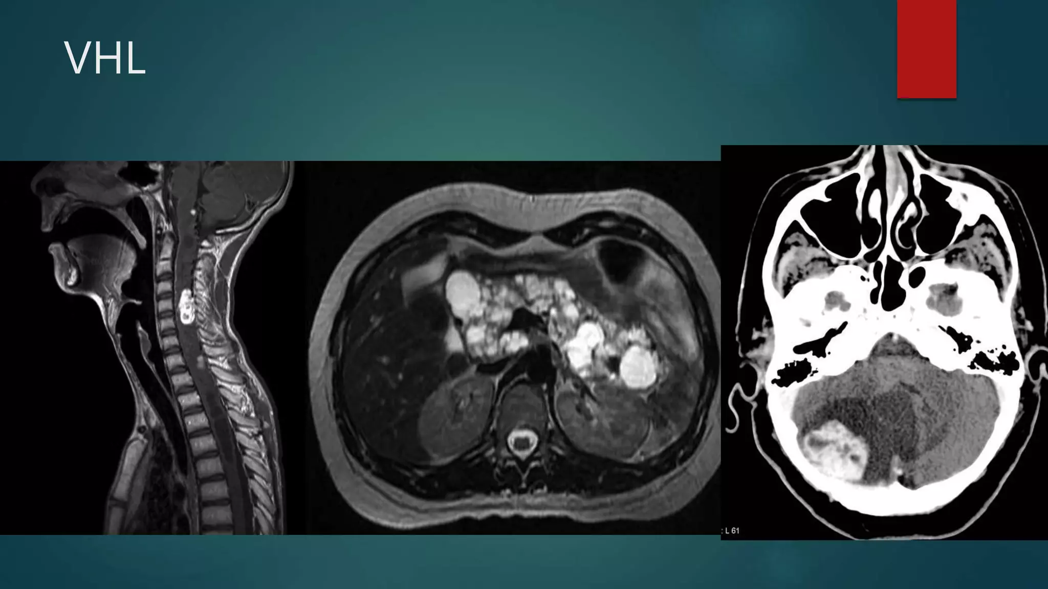 VHL
 