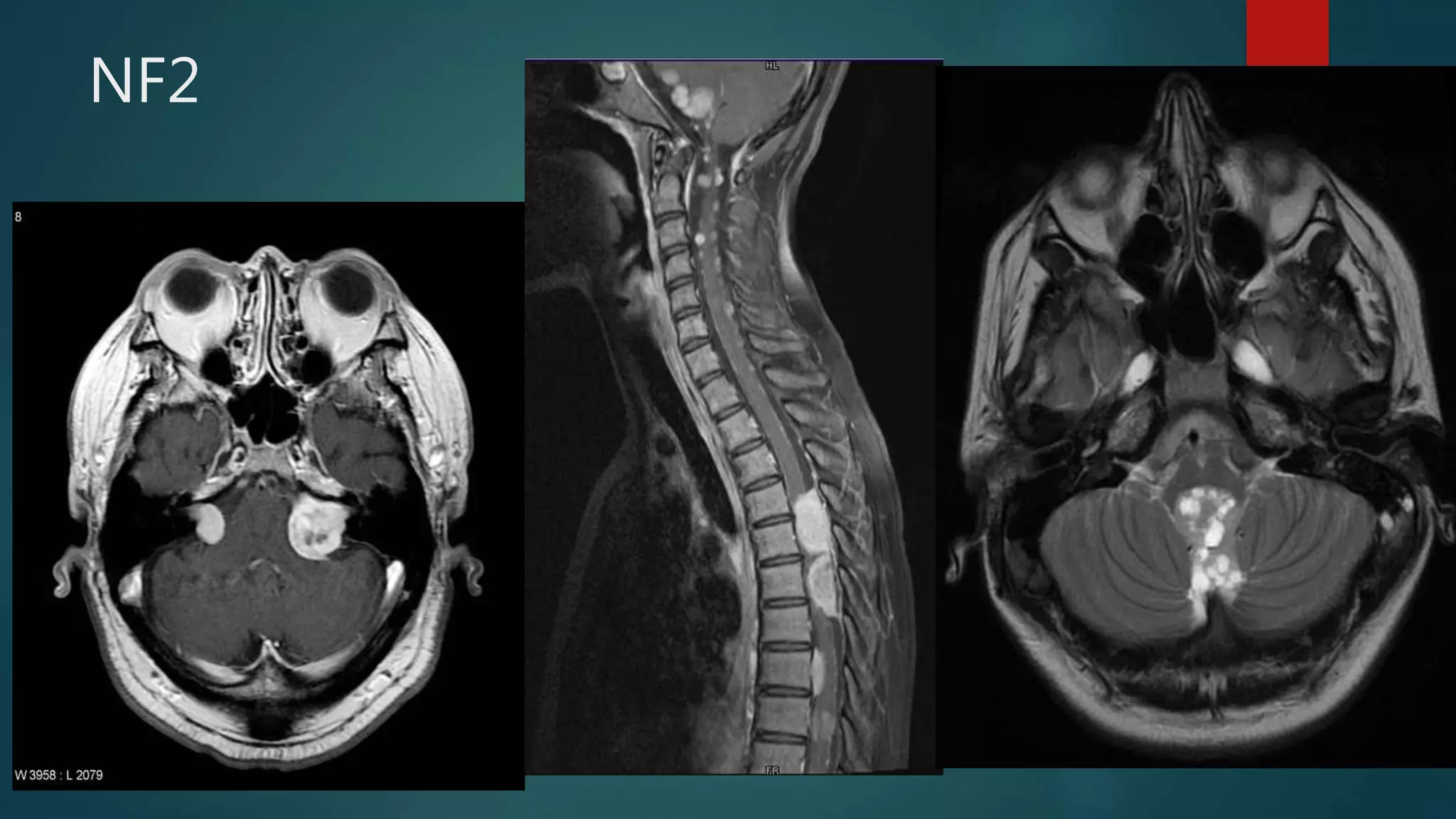 NF2
 