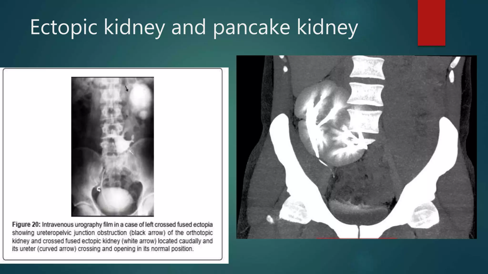 Ectopic kidney and pancake kidney
 