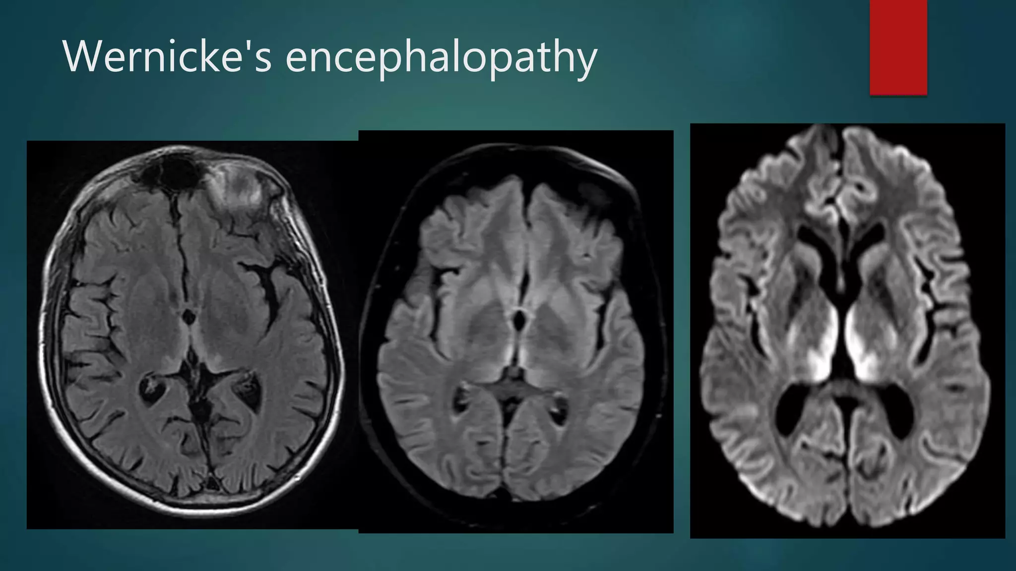 Wernicke's encephalopathy
 