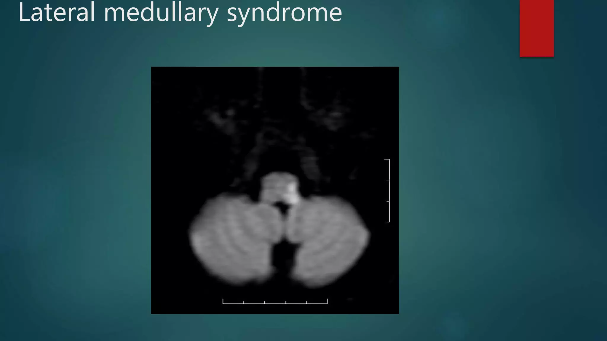 Lateral medullary syndrome
 