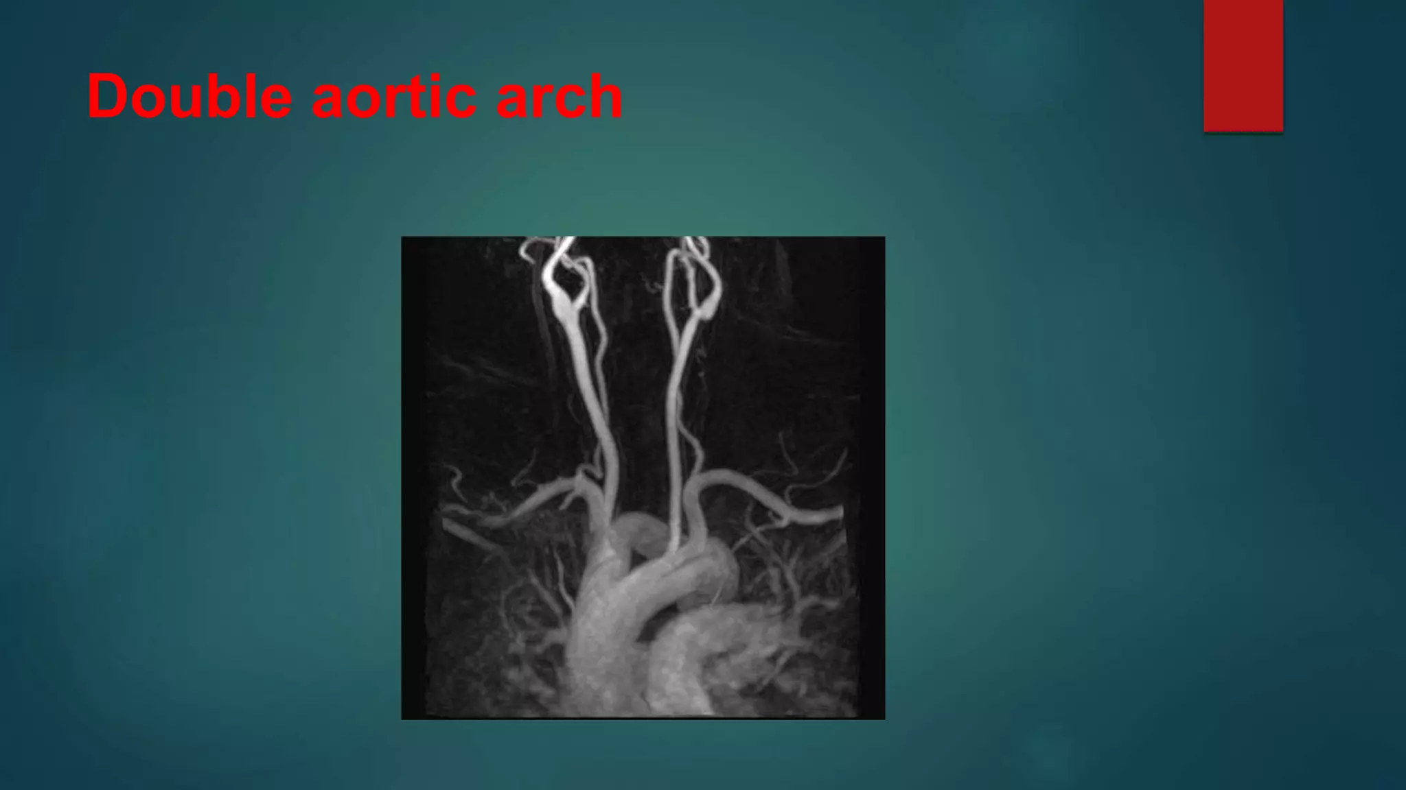 Double aortic arch
 