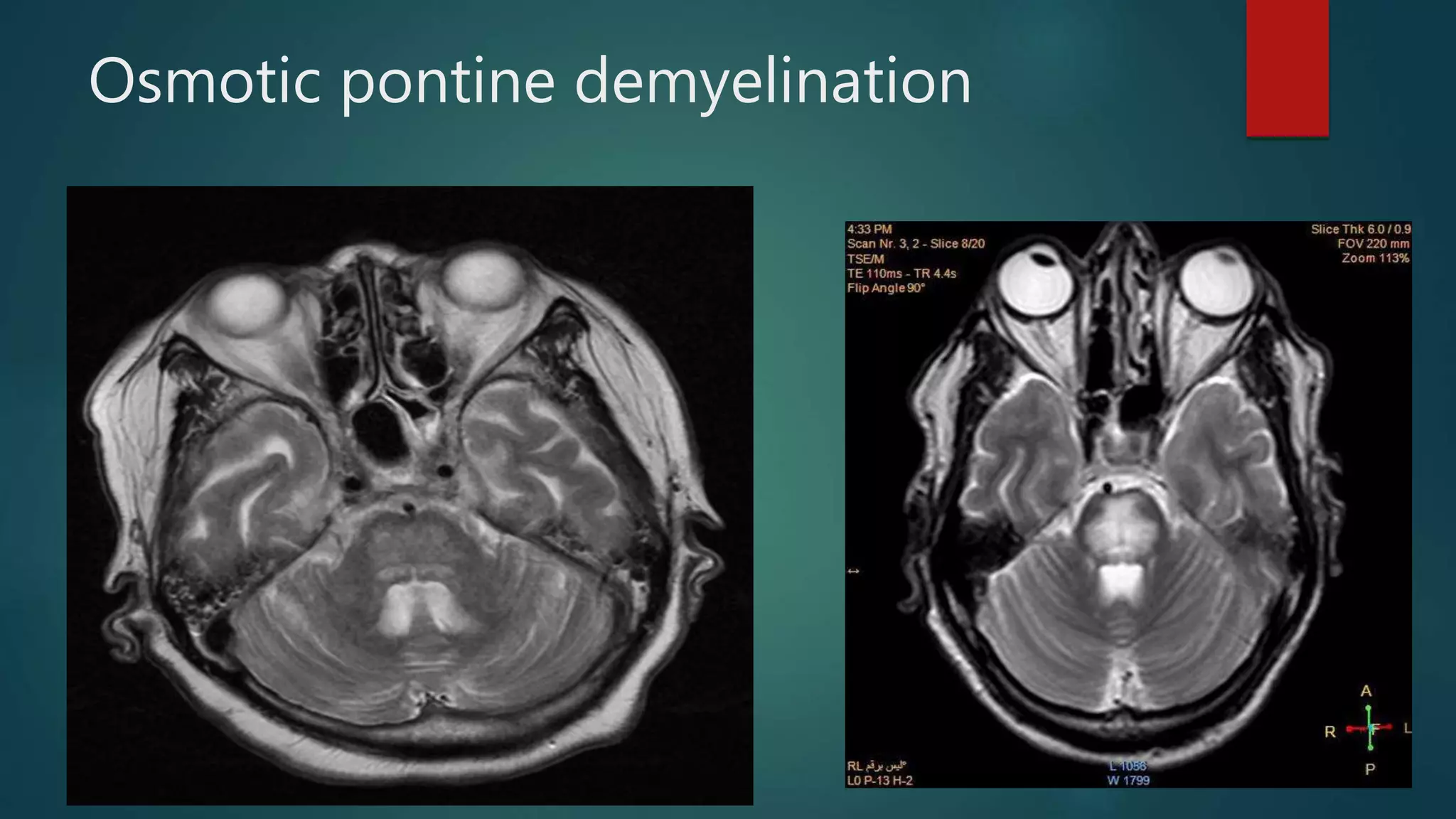 Osmotic pontine demyelination
 
