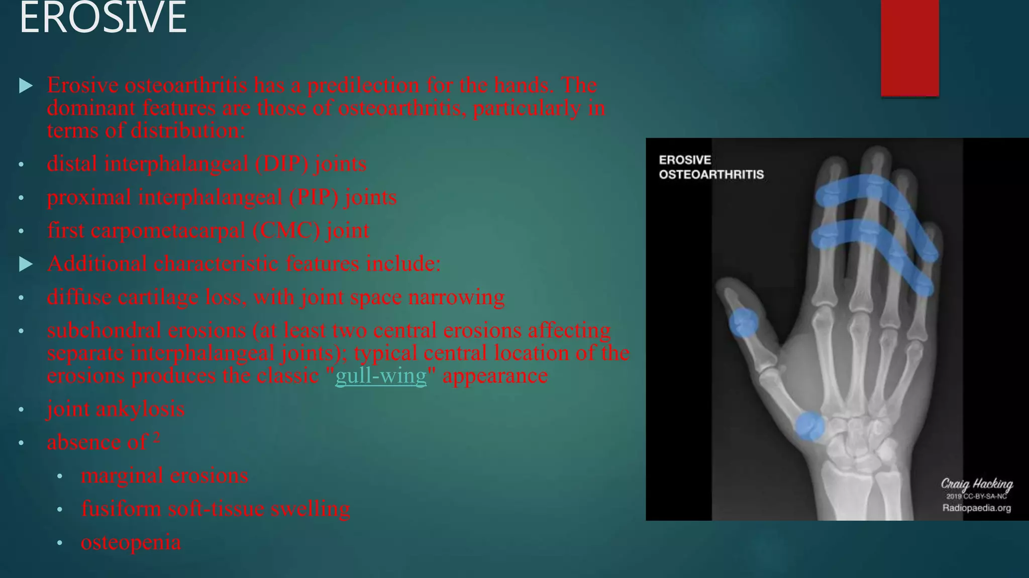 EROSIVE
 Erosive osteoarthritis has a predilection for the hands. The
dominant features are those of osteoarthritis, particularly in
terms of distribution:
• distal interphalangeal (DIP) joints
• proximal interphalangeal (PIP) joints
• first carpometacarpal (CMC) joint
 Additional characteristic features include:
• diffuse cartilage loss, with joint space narrowing
• subchondral erosions (at least two central erosions affecting
separate interphalangeal joints); typical central location of the
erosions produces the classic "gull-wing" appearance
• joint ankylosis
• absence of 2
• marginal erosions
• fusiform soft-tissue swelling
• osteopenia
 