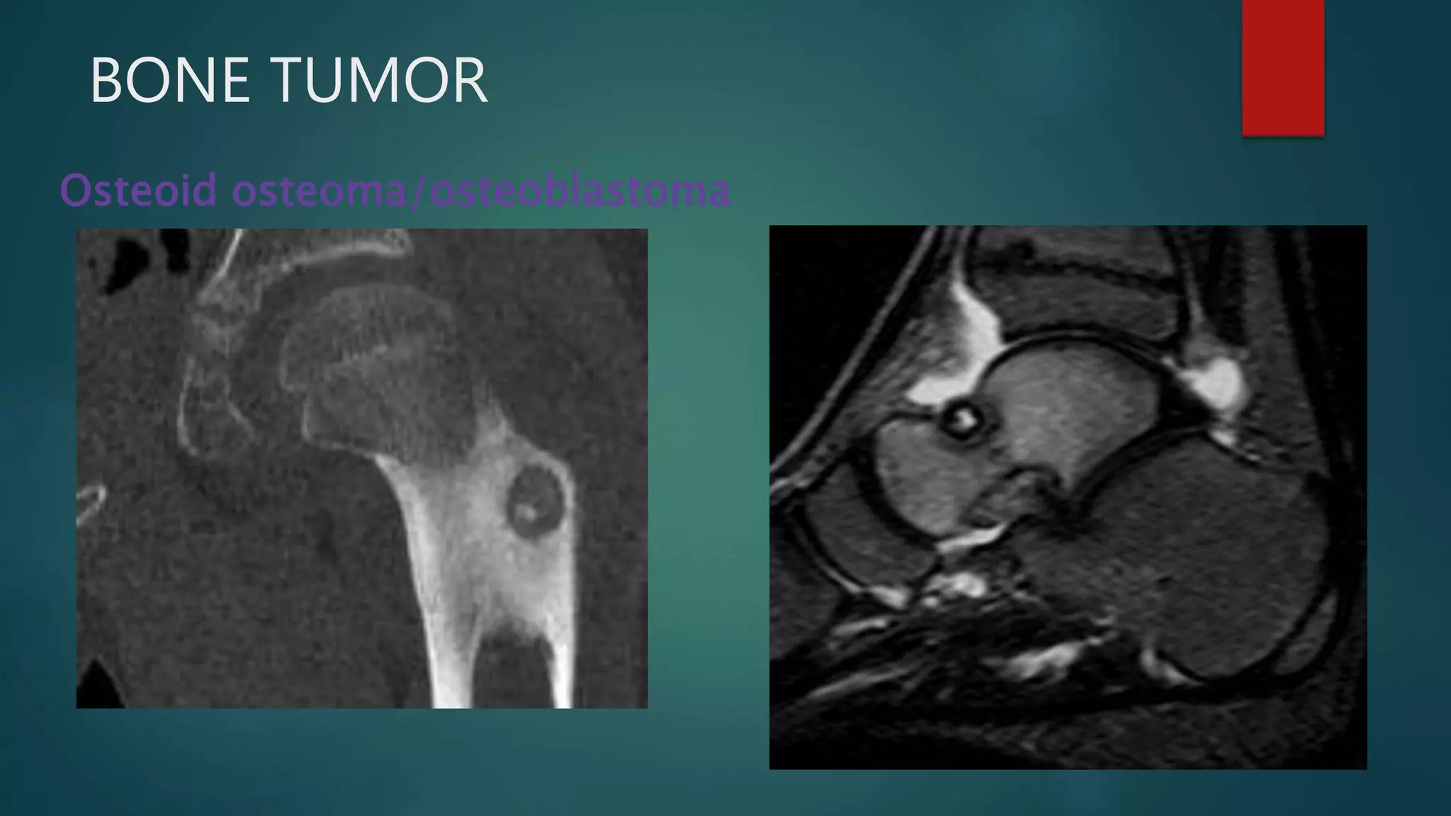 BONE TUMOR
Osteoid osteoma/osteoblastoma
 