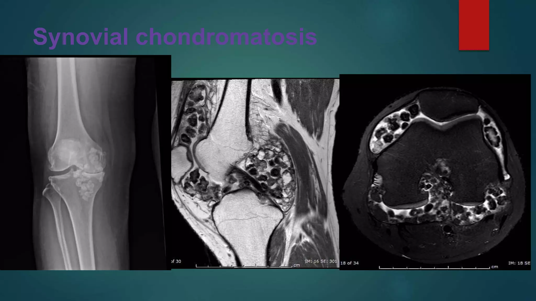 Synovial chondromatosis
 