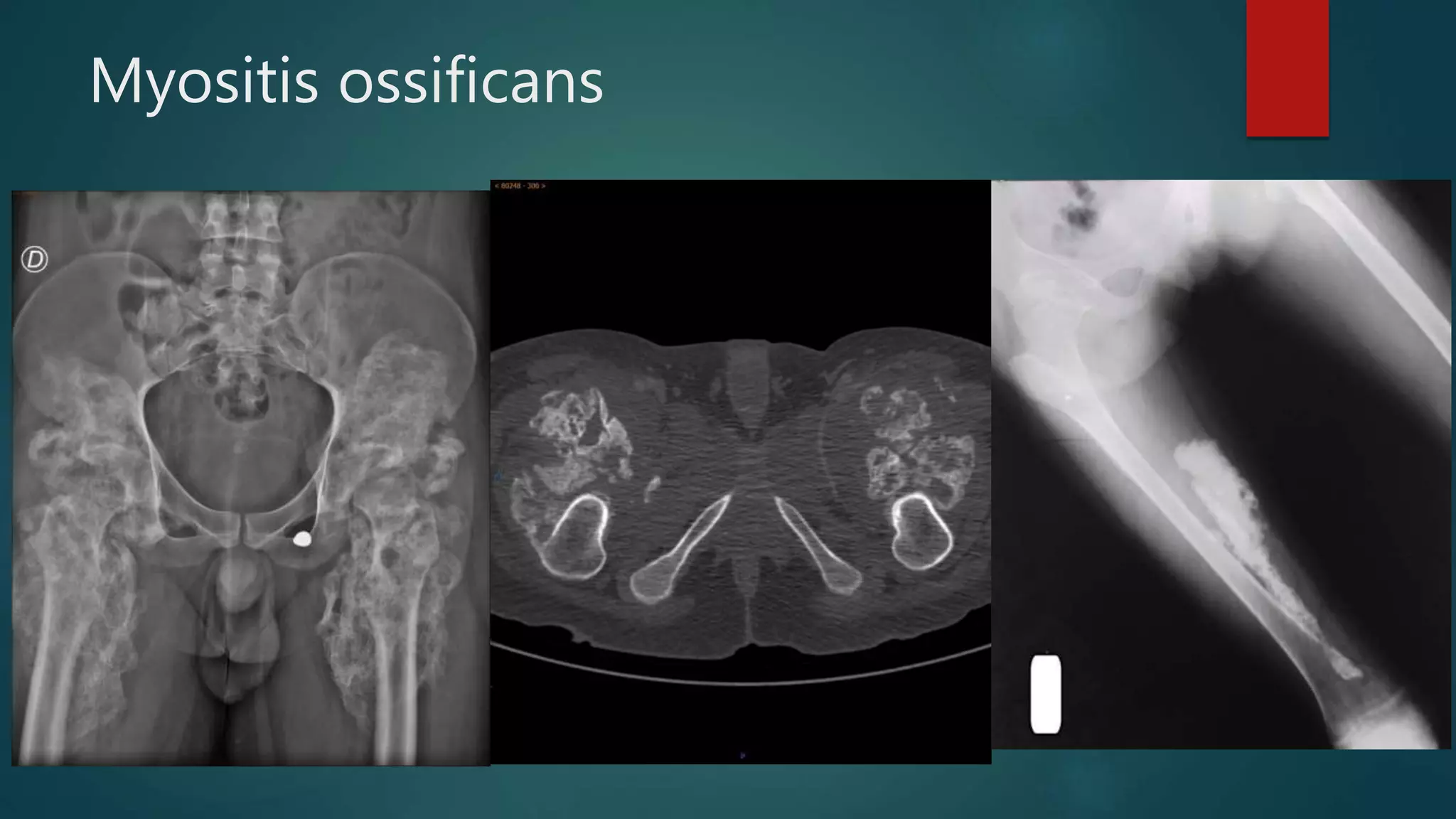 Myositis ossificans
 