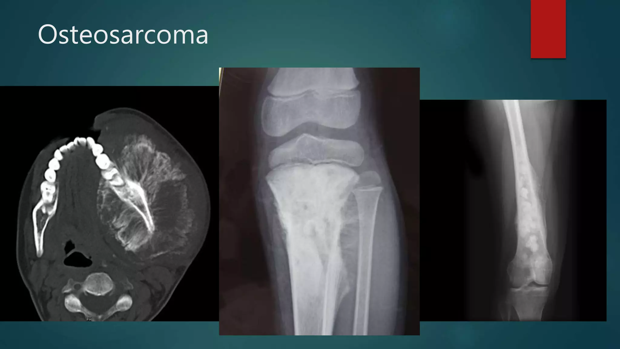 Osteosarcoma
 