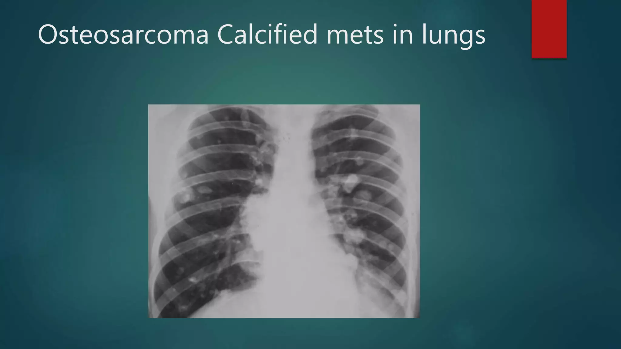 Osteosarcoma Calcified mets in lungs
 