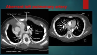 Aberrant left pulmonary artery
 