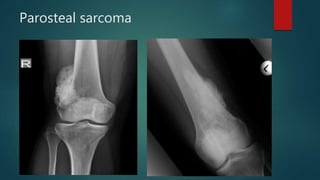 Parosteal sarcoma
 