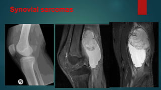 Synovial sarcomas
 