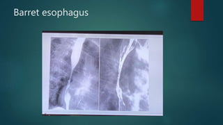 Barret esophagus
 