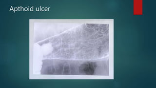 Apthoid ulcer
 