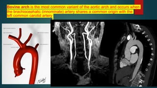 Bovine arch is the most common variant of the aortic arch and occurs when
the brachiocephalic (innominate) artery shares a common origin with the
left common carotid artery
 