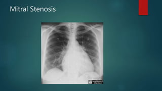 Mitral Stenosis
 