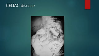 CELIAC disease
 