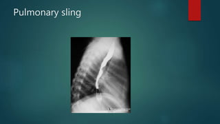 Pulmonary sling
 