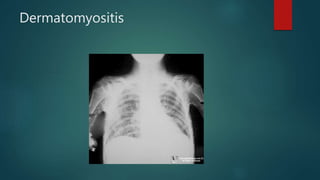 Dermatomyositis
 