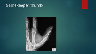 Gamekeeper thumb
 