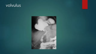 volvulus
 