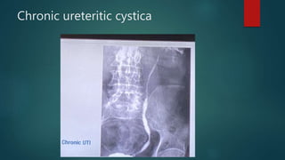 Chronic ureteritic cystica
 