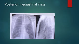 Posterior mediastinal mass
 