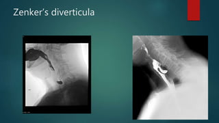 Zenker’s diverticula
 