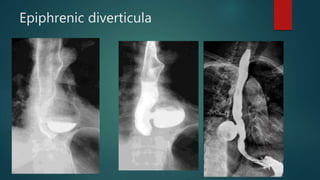 Epiphrenic diverticula
 
