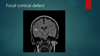 Focal cortical defect
 
