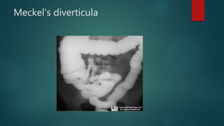 Meckel's diverticula
 