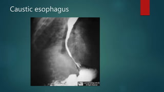 Caustic esophagus
 