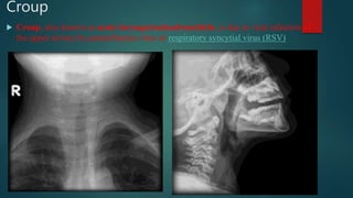 Croup
 Croup, also known as acute laryngotracheobronchitis, is due to viral infection of
the upper airway by parainfluenza virus or respiratory syncytial virus (RSV)
 