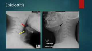 Epiglottitis
 