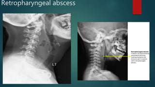 Retropharyngeal abscess
 